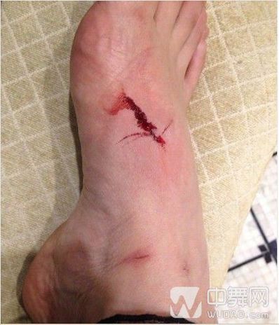 脚受伤后的感悟 跑步脚受伤住院的感想作文